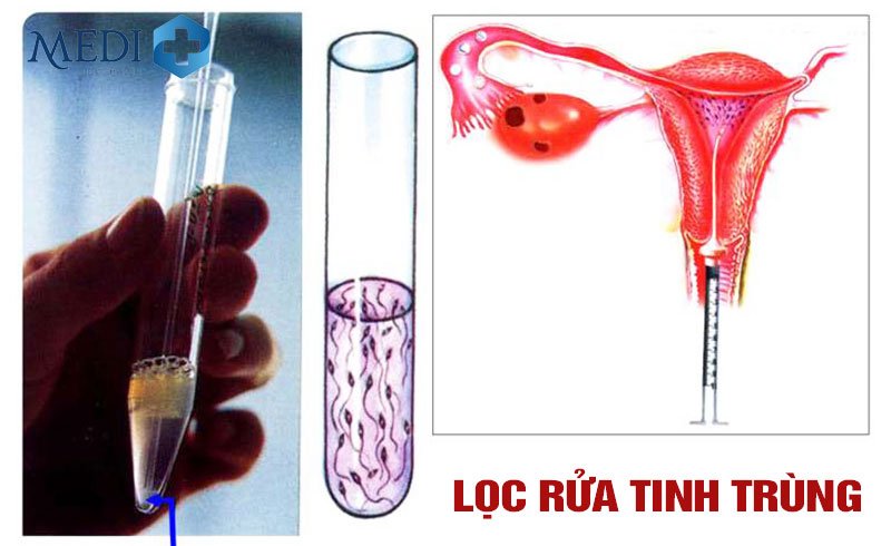 loc-rua-tinh-trung-bom-iui